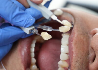 Caring for Your Dental Crowns and Bridges