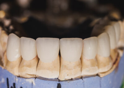 Close-Up Of A Gypsum Dentures With Porcelain Teeth