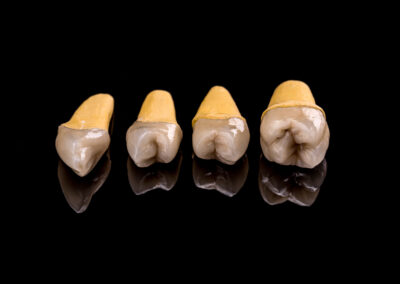 Dental-Crowns-and-Bridges