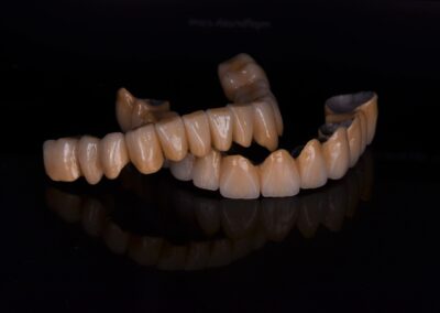 Close-up shot of metal-ceramic crowns on a black surfaceClose-up shot of metal-ceramic crowns on a black surface