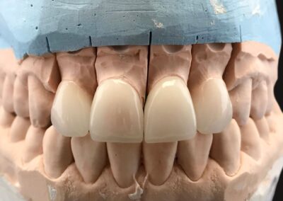 Dental gypsum model in dentist laboratory office - close-up. Gypsum Dentures with porcelain teeth