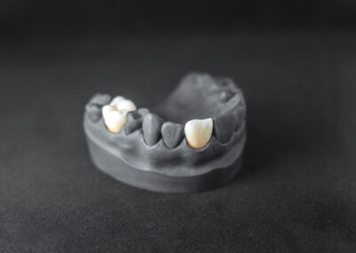 Model of artificial jaw with dental implant