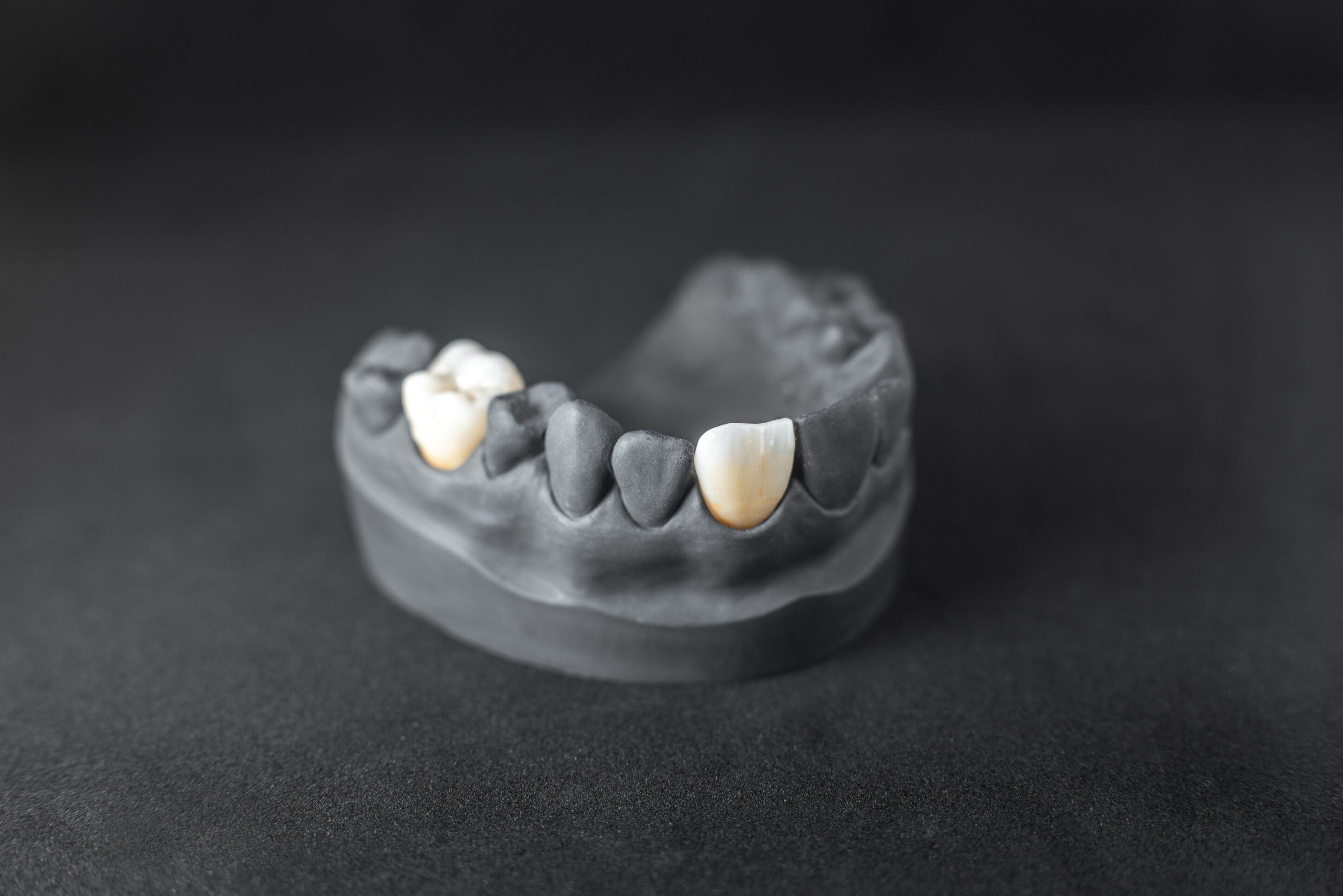 Model of artificial jaw with dental implant